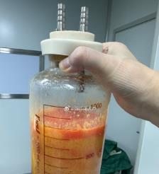 安徽水动力吸脂手术要做多久？